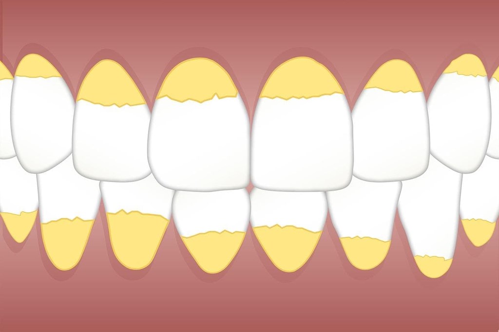 3 claves para evitar el sarro en los dientes