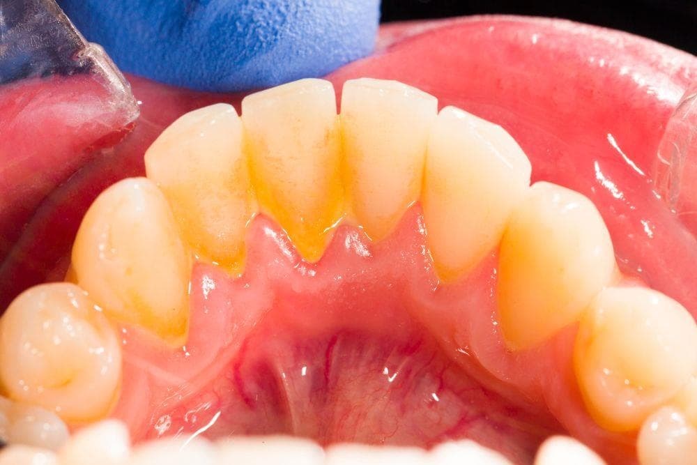 3 claves para evitar el sarro en los dientes - Imagen 1