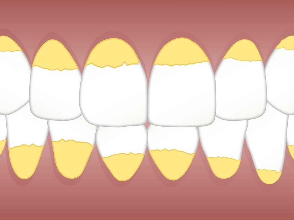 3 claves para evitar el sarro en los dientes