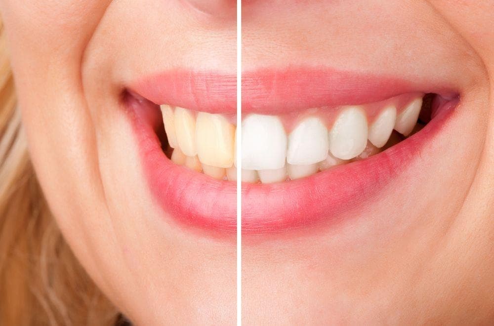 5 consejos para que el blanqueamiento dental dure más tiempo