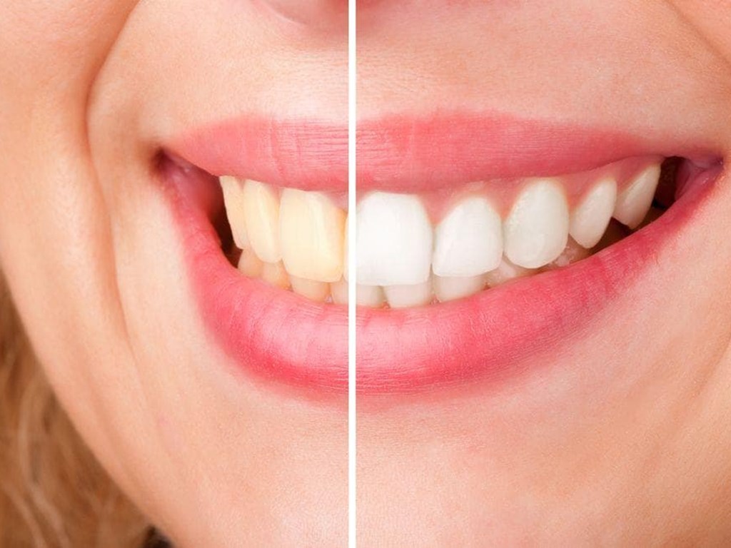 5 consejos para que el blanqueamiento dental dure más tiempo