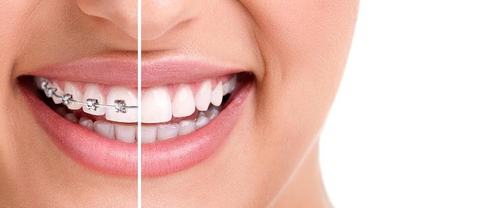 5 tipos de aparatos dentales y correctores