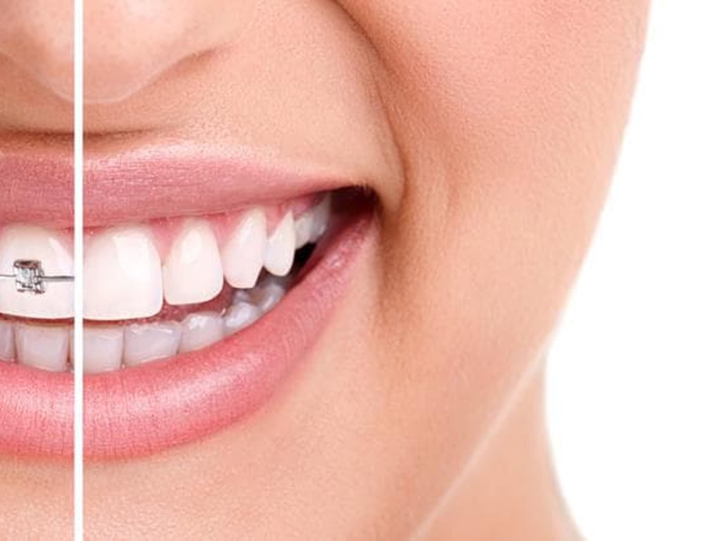 5 tipos de aparatos dentales y correctores