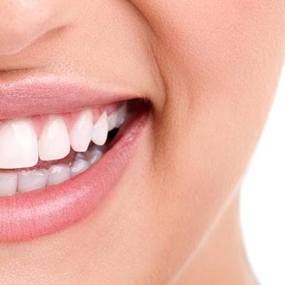 5 tipos de aparatos dentales y correctores