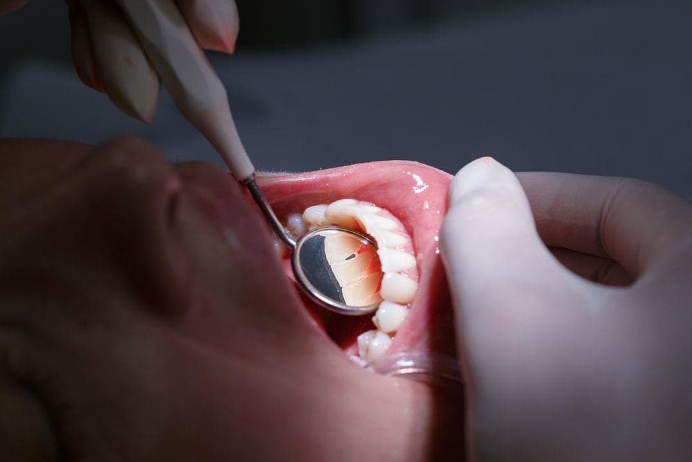 6 cosas que no sabías sobre la enfermedad periodontal