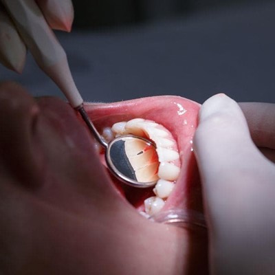6 cosas que no sabías sobre la enfermedad periodontal