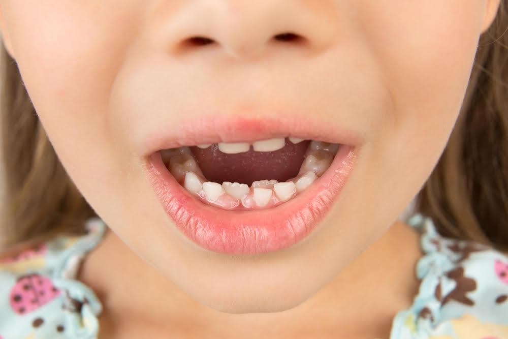 ¿A qué edad se le caen los dientes de leche a los niños?