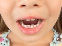 ¿A qué edad se le caen los dientes de leche a los niños?