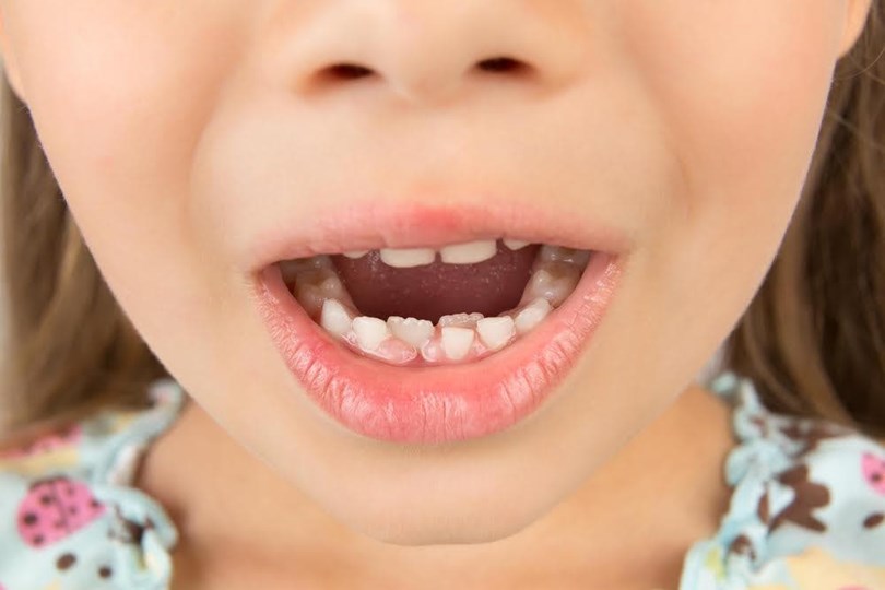 Caida De Dientes De Leche ¿A quĆ© edad se le caen los dientes de leche a los niƱos?