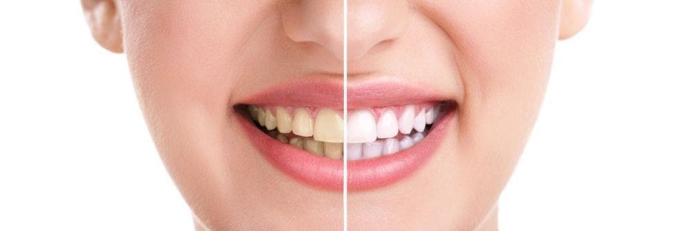 Blanqueamiento dental: todo lo que debes saber