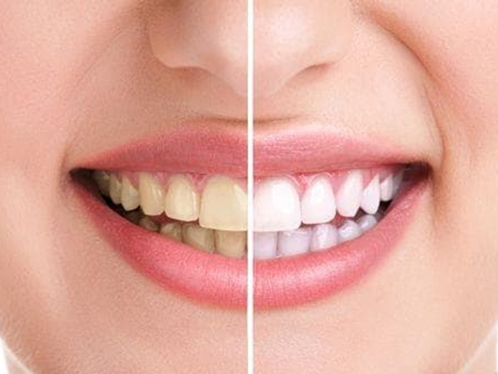 Blanqueamiento dental: todo lo que debes saber