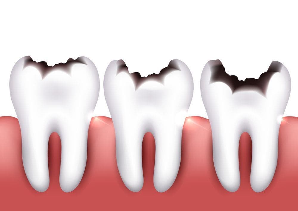 Caries dental: cómo afecta resto los CUERPO