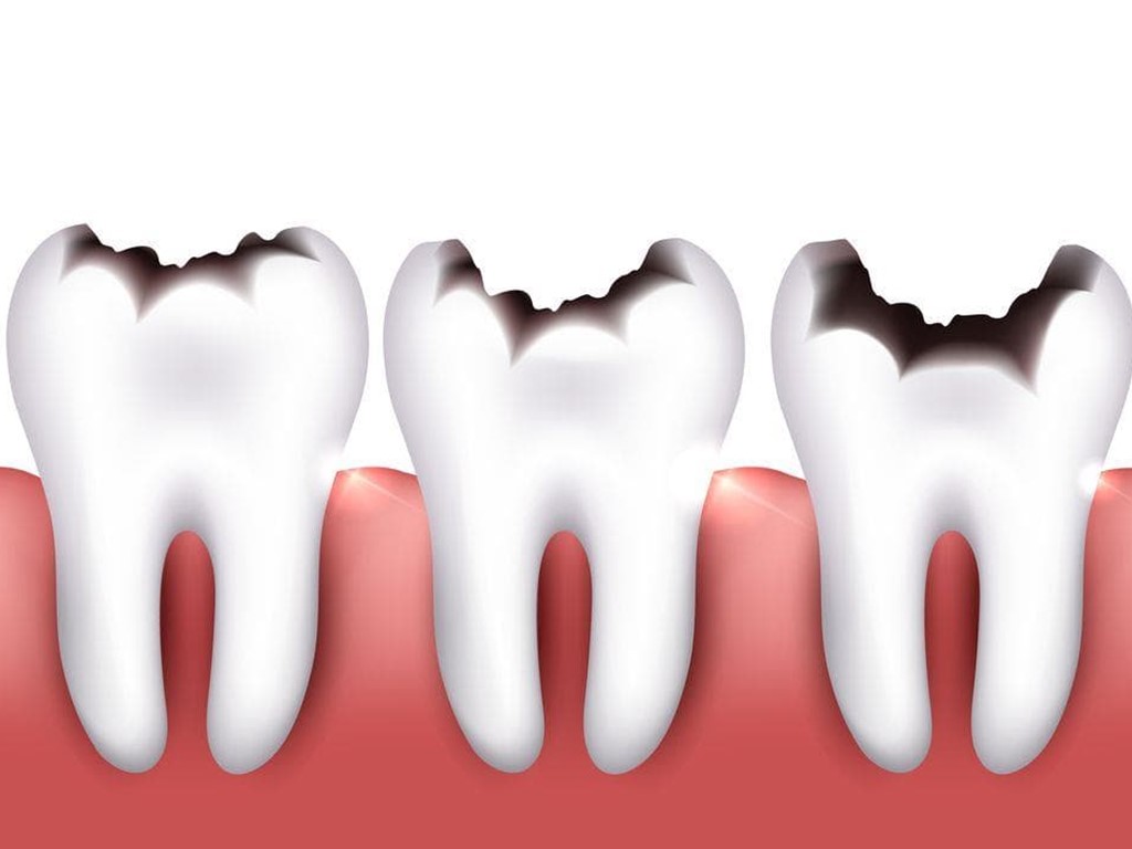 Caries dental: cómo afecta al resto de los órganos del CUERPO