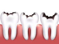 Caries dental: cómo afecta al resto de los órganos del CUERPO