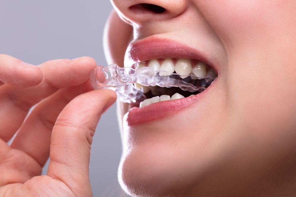¿Cómo la ortodoncia invisible puede mejorar tu calidad de vida?