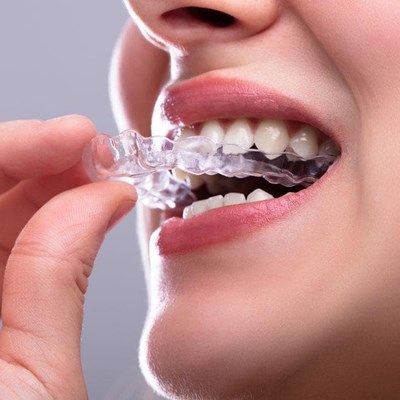 ¿Cómo la ortodoncia invisible puede mejorar tu calidad de vida?
