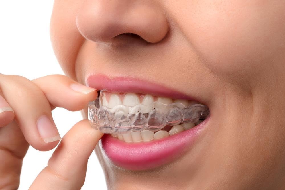 ¿Cuánto dura un tratamiento de Invisalign? | Todas sus fases - Imagen 1