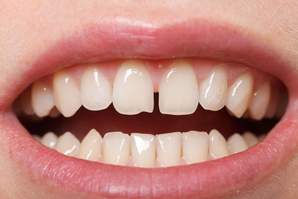 Diastema: qué es, causas y tratamientos