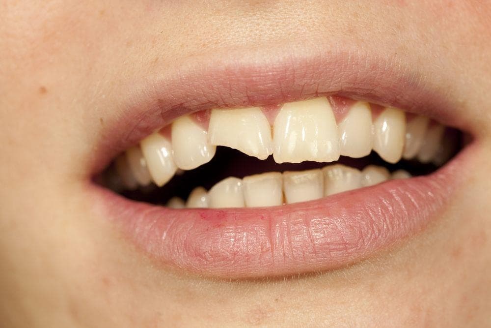 Estos son los 3 problemas dentales más frecuentes - Imagen 2