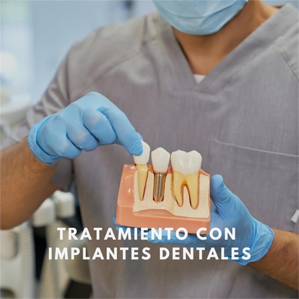 Implantes dentales: proceso, beneficios y cuidados a largo plazo