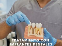 Implantes dentales: proceso, beneficios y cuidados a largo plazo
