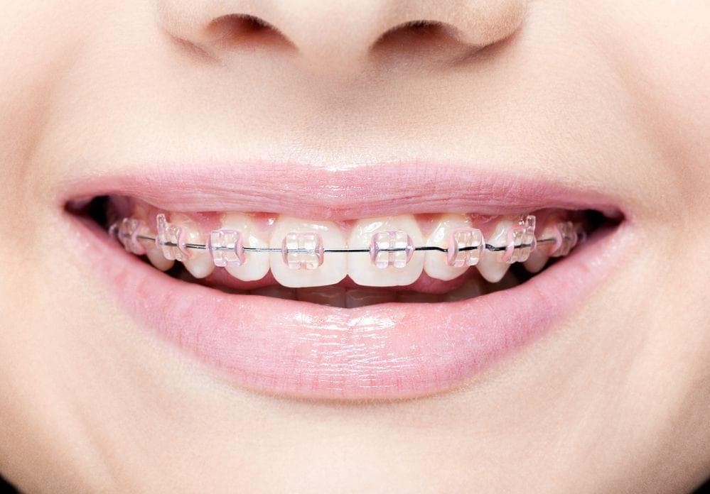 Los alimentos que no puede comer cuando le ponen brackets - Imagen 1