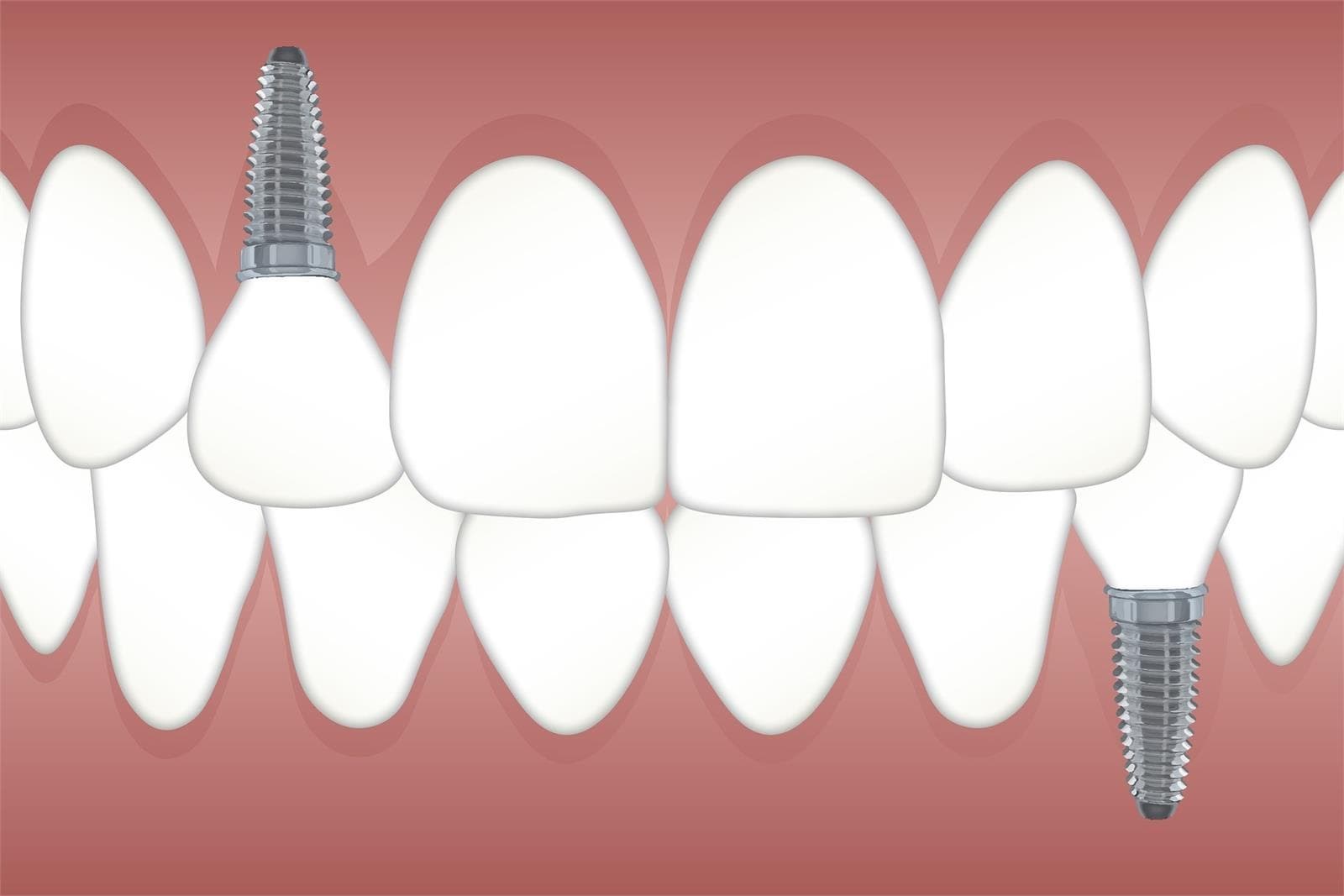 Los cuidados después de un implante dental - Imagen 1
