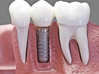Los cuidados después de un implante dental