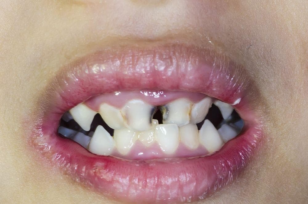 ¿Los niños pueden sufrir caries en los dientes de leche? - Imagen 1