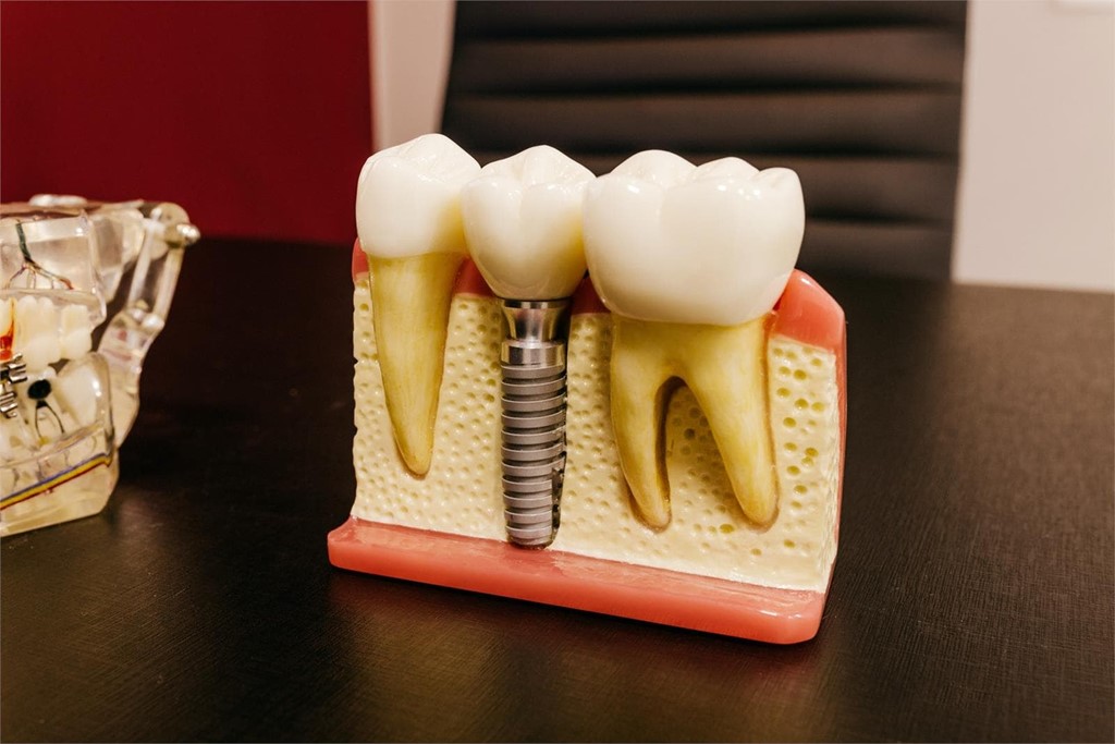 Postoperatorio de implantes dentales | 5 Cuidados y consejos a seguir