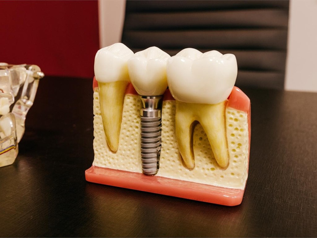 Postoperatorio de implantes dentales | 5 Cuidados y consejos a seguir