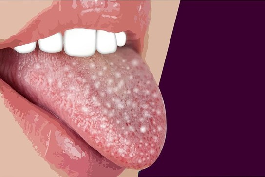 ¿Qué enfermedades suelen afectar a la lengua? - Imagen 1