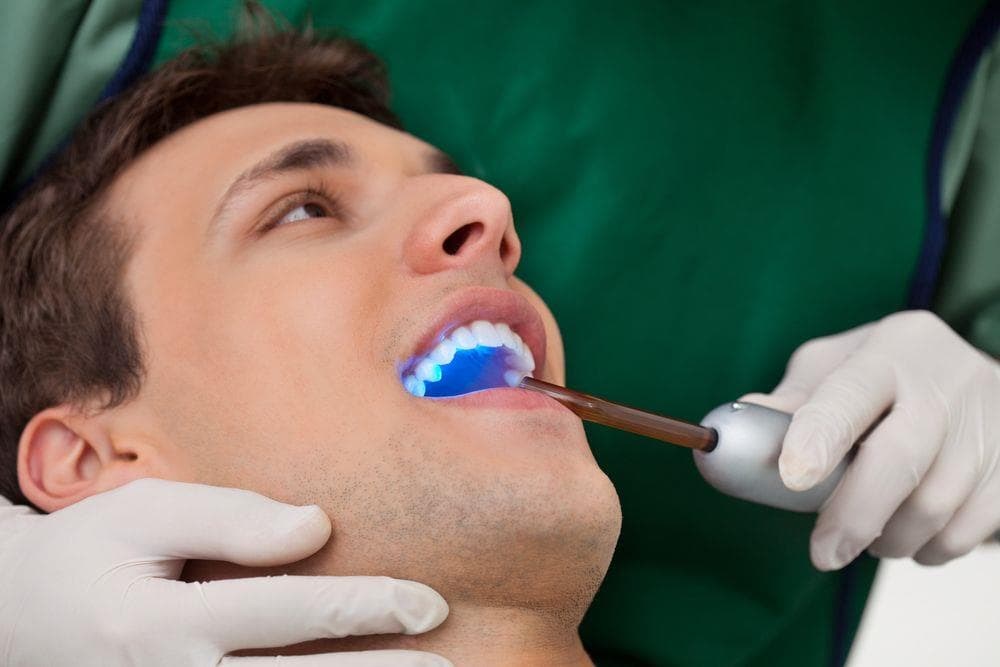 ¿Qué es un sellado dental y cuándo es necesario?