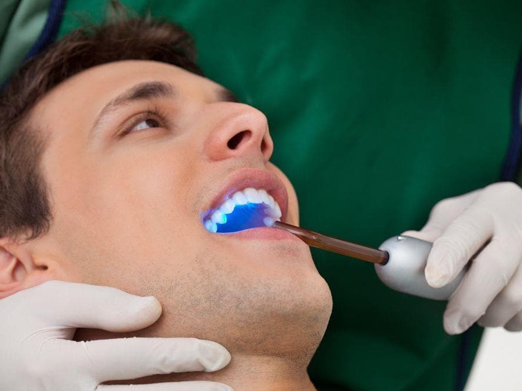 ¿Qué es un sellado dental y cuándo es necesario?