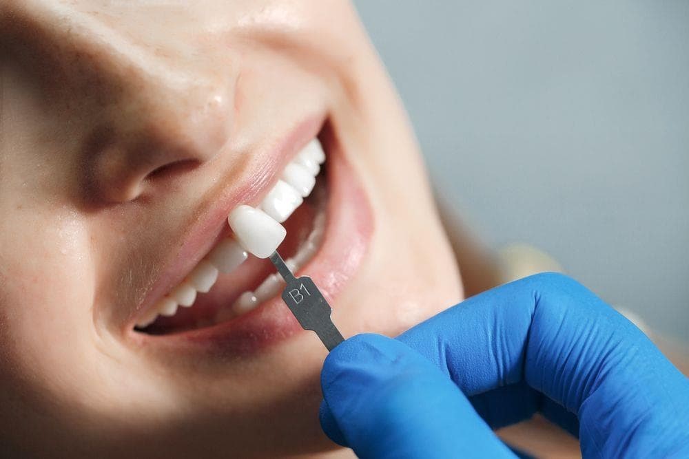 ¿Qué son los microimplantes dentales?