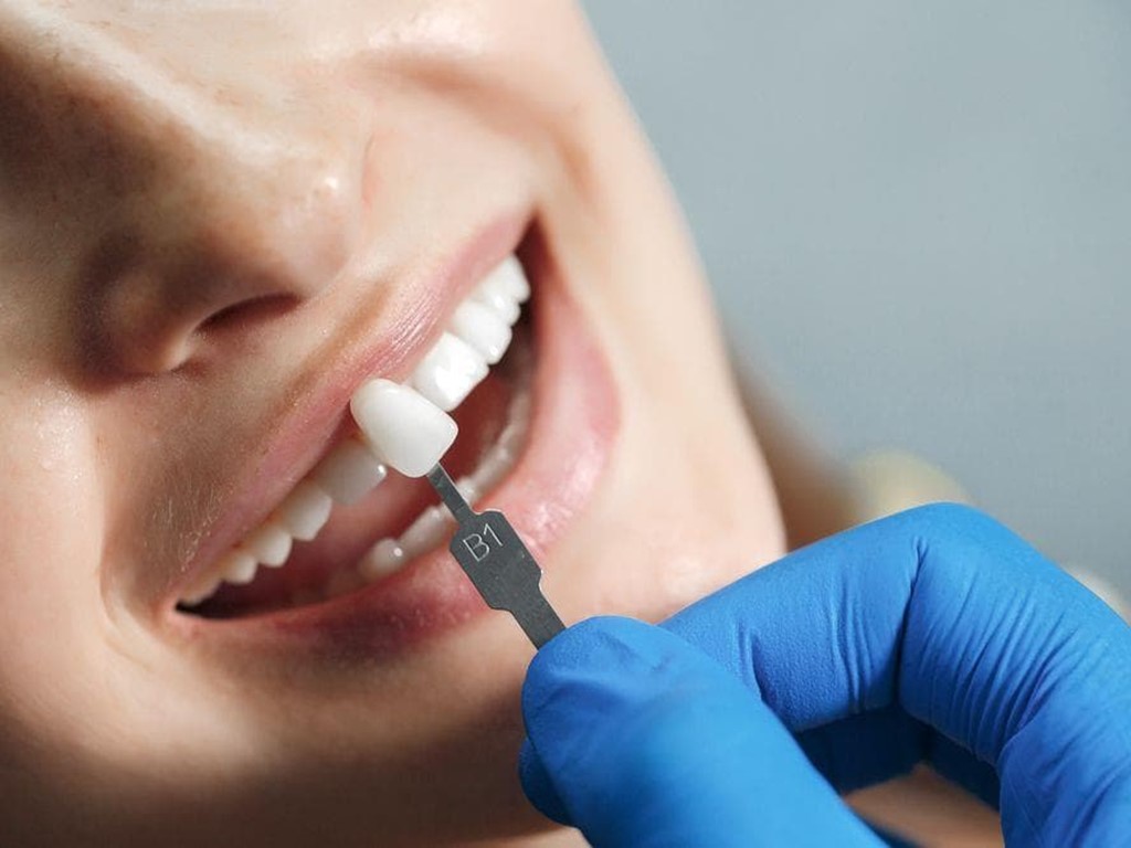 ¿Qué son los microimplantes dentales?