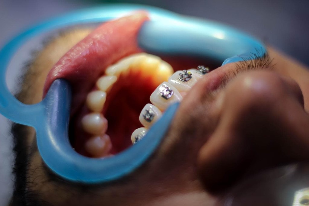 ¿Qué son los microimplantes en ortodoncia?