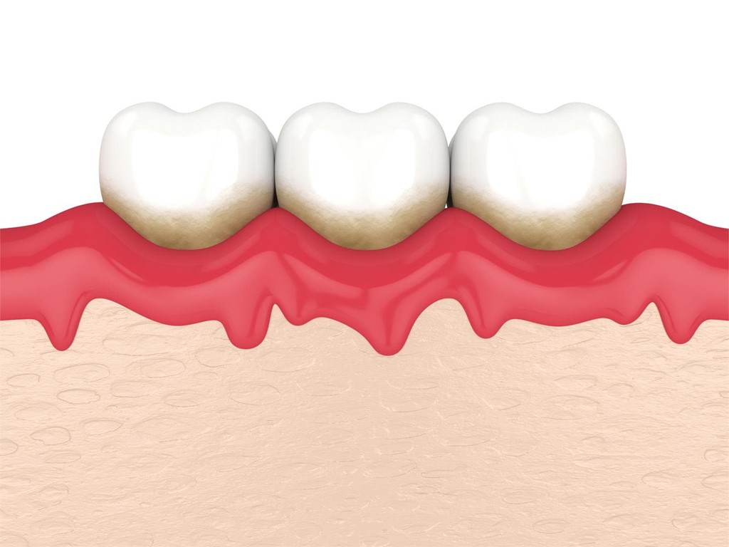 Síntomas de las encías inflamadas, causas y tratamientos